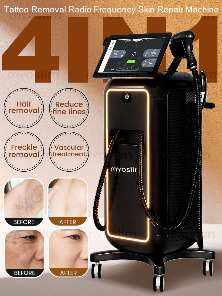 Industrial Laser Hair Removal Machine - Machine d'épilation indolore 4-en-1 Soprano Titanium