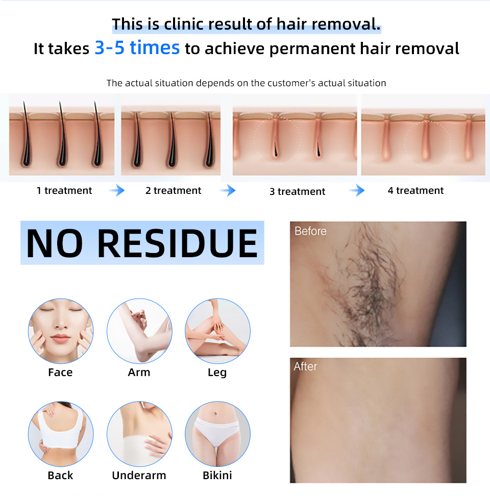 Prix d'usine 20000000   Beat 8 - Industrial Laser Hair Removal Machine avis et prix